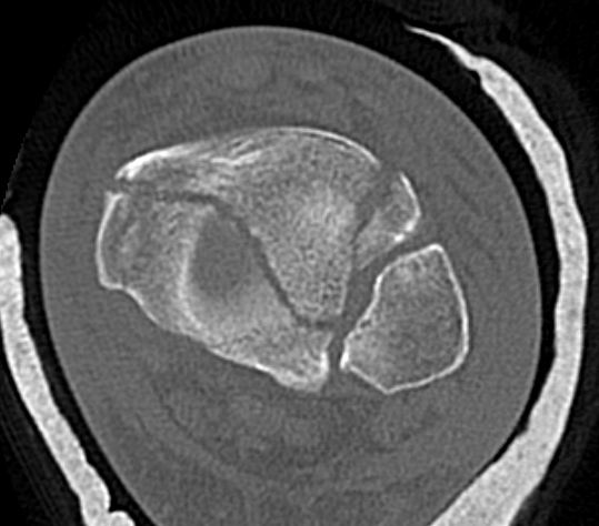 Tibial plafond medial